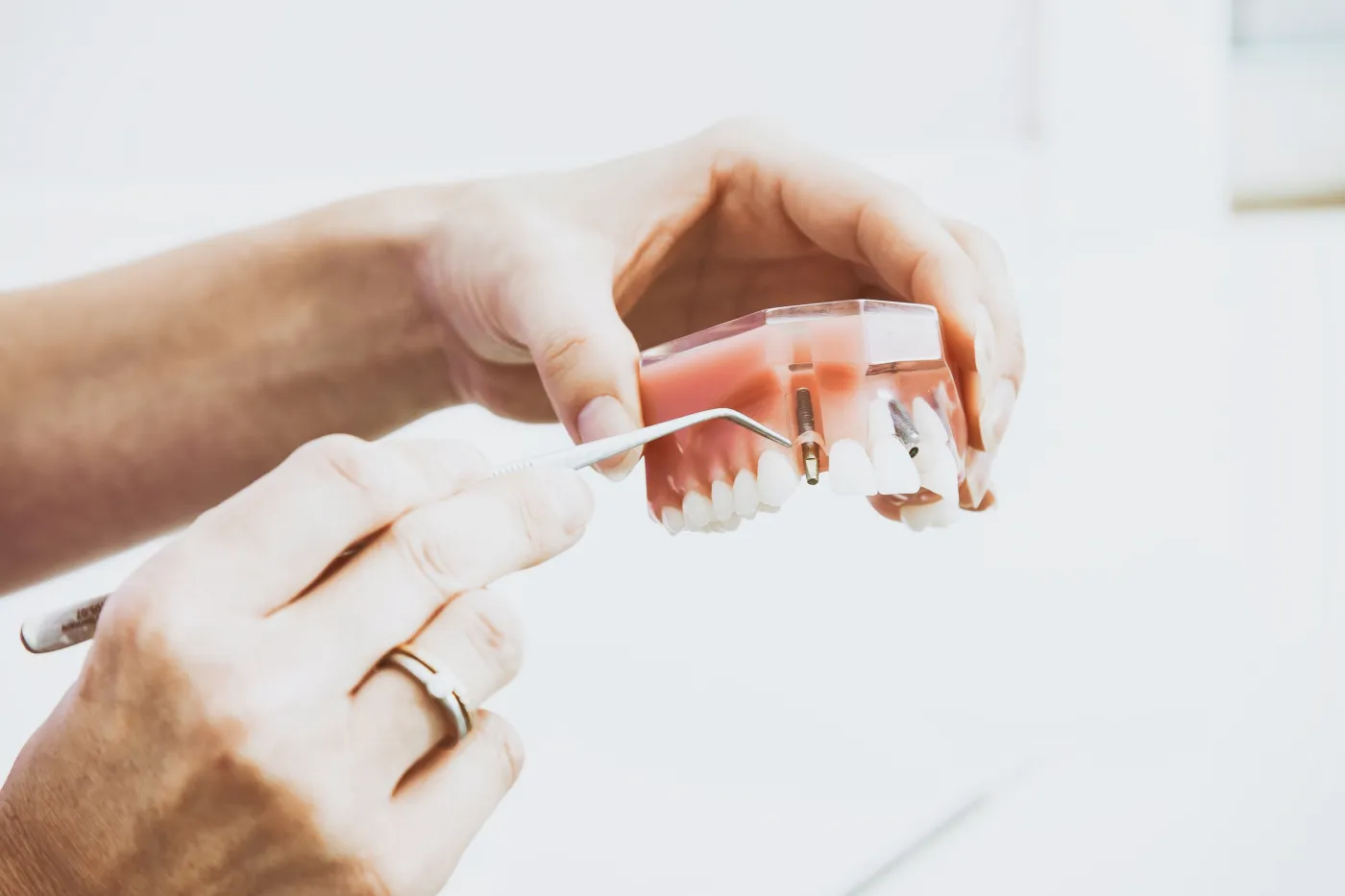 Les implants dentaires