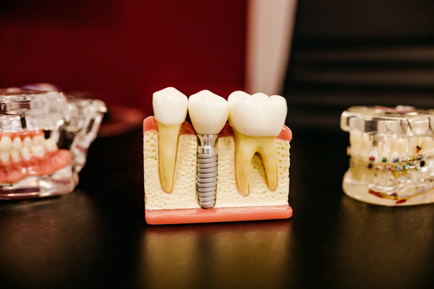 Maquette d'un implant dentaire entre deux dents
